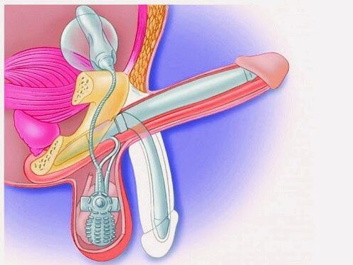 Ampliación de pene con prótesis de pene