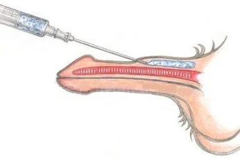 Un método peligroso para agrandar el pene mediante inyecciones de vaselina.